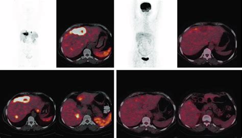 Ga Ga Dotatate And F F Fdg Pet Ct In A Patient Of Cup Net