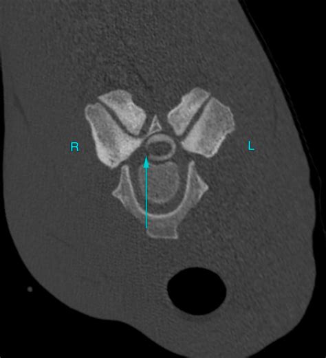 Image:Transverse CT, myelogram, cervical vertebral column, horse-MSD