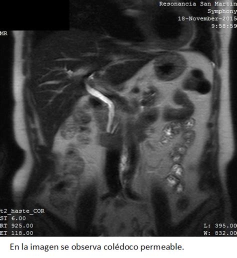 Pancreatitis recurrente secundaria a disfunción del esfínter de Oddi