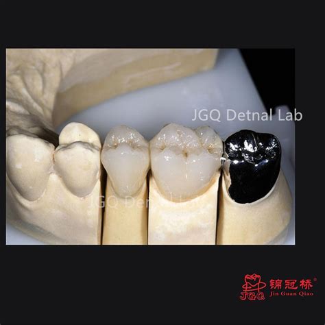 Permanent Pfm Dentures Metal Ceramic Restoration Dental Crowns Made In