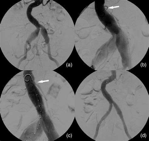 Case 1 Intraoperative Angiography A Bilateral Common Iliac Artery