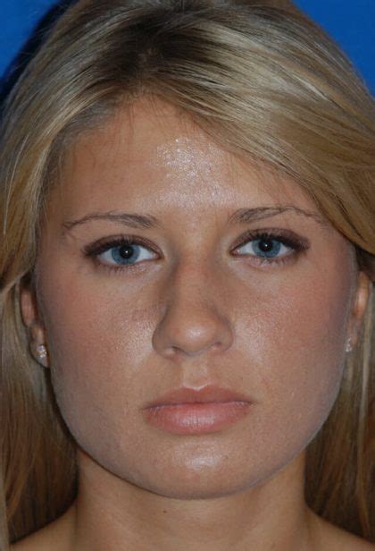 Patient Primary Rhinoplasty Before And After Photos Englewood