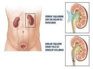 Şifalı Bitkilerim Böbrek Taşlarının Tedavisi