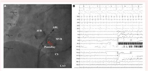 Figure 1 From A Case Report Of Entrapment Of PentaRay Catheter In The