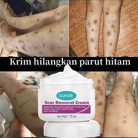 Effective Scar Removal Cream G Peklat Remover Legit Scars