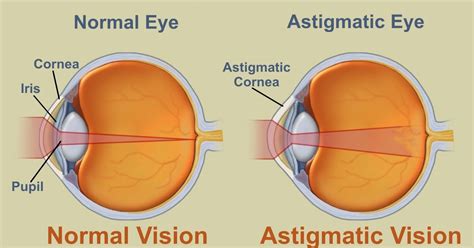 Vision Source New Westminster: What is Astigmatism?