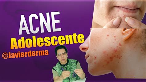 El Acné Adolescente Como Quitar El Acné Javierderma Youtube