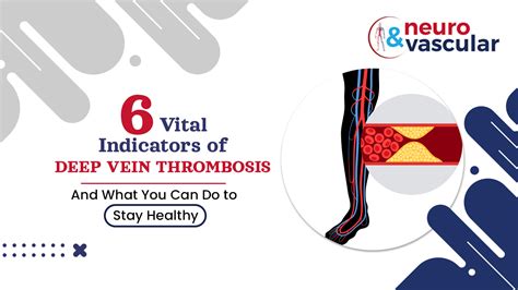 6 Vital Indicators Of Deep Vein Thrombosis