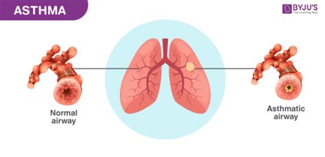 Asthma Symptoms Causes Diagnosis Types And Treatment