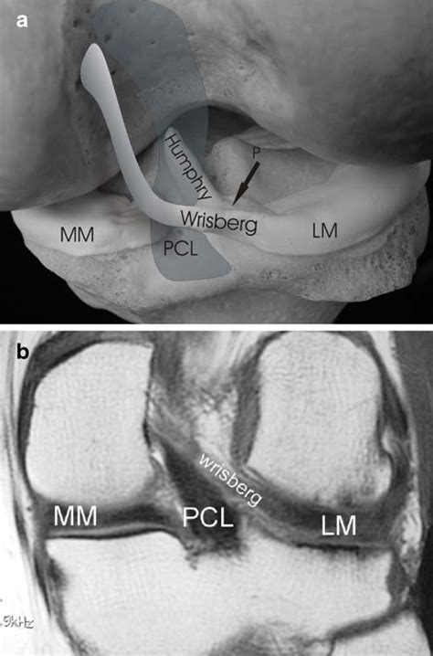 Anterior Meniscofemoral Ligament