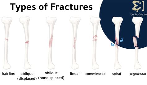 Leg fracture, how to determine its type and methods of treatment - Dr ...