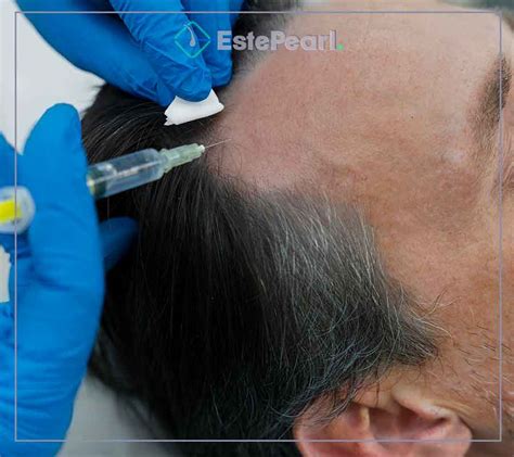 Hair Transplant Procedure Steps - Este Pearl