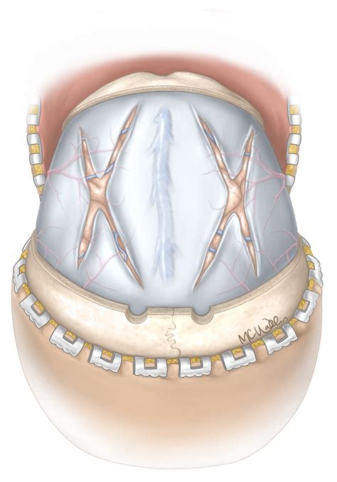 Decompressive Craniectomy Wallin Biovisuals