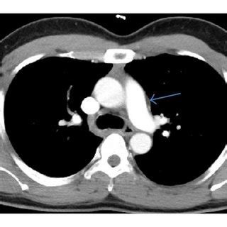 Axial Ct Scans Of The Chest A Mediastinal Window B Lung Window