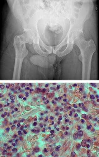 Pathological Fracture Due To Lytic Lesion Caused By A Myeloid Neoplasm