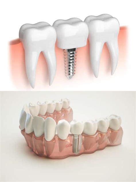 Dental Implants Near Me -Buffalo, NY A Comprehensive Guide