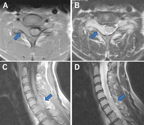 T1 And T2 Weighted Axial Mri Of The Cervical Spine Showed An Eden Type