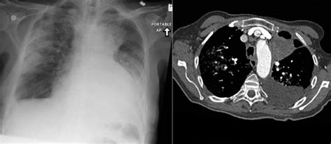 The Thoracic Aorta | Radiology Key