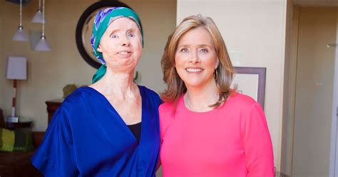Charla Nash opens up about recent face transplant setback, living