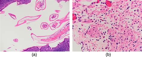 Enterobius Vermicularis Associated Appendicitis A 22 Year Case Series And Comprehensive Review