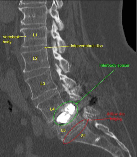 L3 S1 Laminectomy And Fusion Complete Orthopedics NY