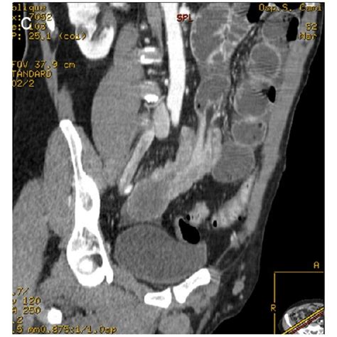 Enteroenteric Ileoileal Intussusception Bowel Wall Of Download Scientific Diagram