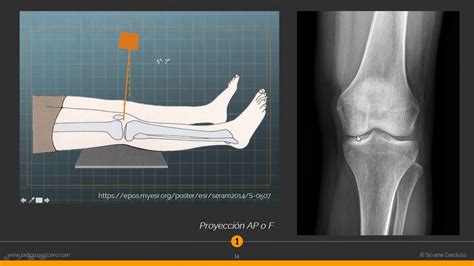 Anatom A Radiol Gica De La Rodilla A Parte Youtube