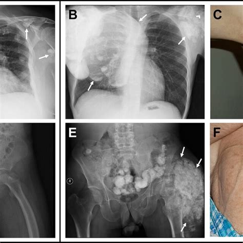 Examples Of Soft Tissue Calcifications In Hyperphosphatemic Familial