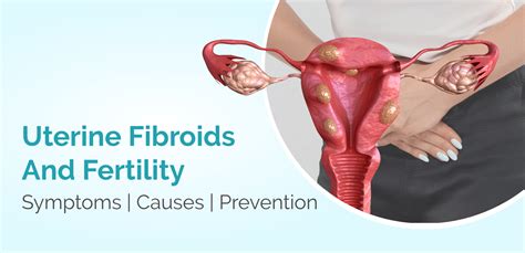 Uterine Fibroids And Fertility Symptoms Causes Prevention