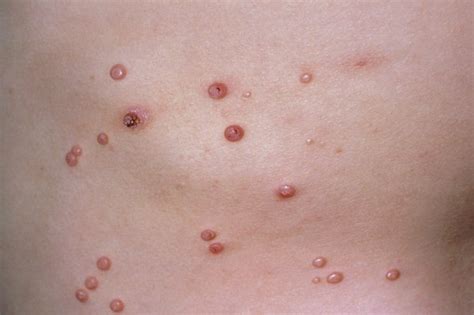 Introduction To Molluscum Contagiosum What Is It Mynewsbuzz