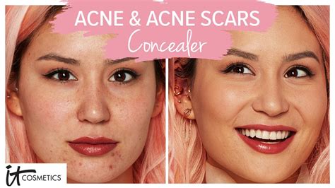 How To Conceal Acne Scars Youtube