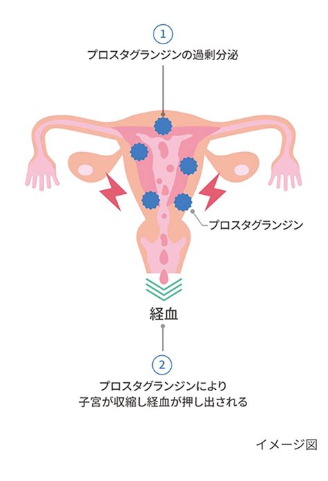 月経困難症とは？毎月つらい生理痛があるときは｜基礎体温でカラダと話そう 【テルモ】