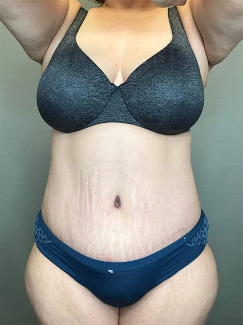 Tummy Tuck Before After Photos Lift Plastic Surgery