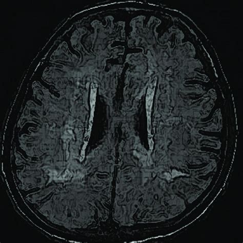 MRI of the brain revealing multi-lobar tuberculomas of the brain. MRI ...