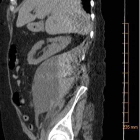 Ct Of Abdomen And Pelvis Without Contrast Showing Large Right Sided Download Scientific