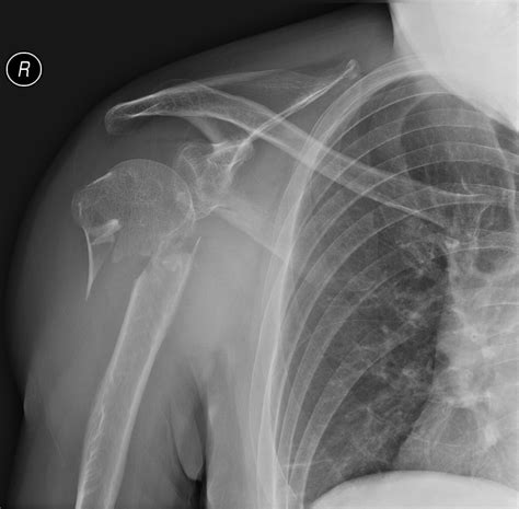 Lipohemarthrosis Of The Shoulder Image Radiopaedia Org