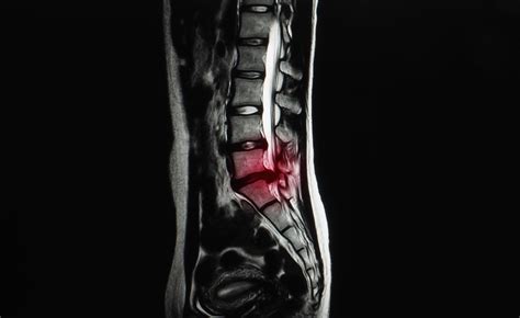 Recovery After Spinal Fusion Alexander Taghva Md Neurosurgery