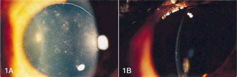 Diffuse Lamellar Keratitis Ophthalmology