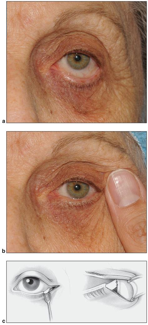 Ectropion Eyelid Surgery Little Rock Sagging Outward Eyelid Procedure