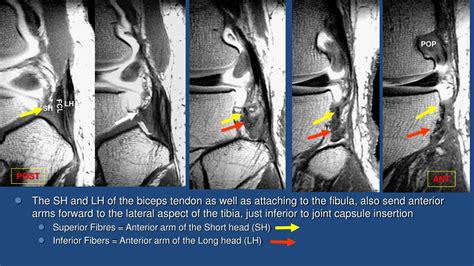 Ppt Posterolateral Corner Of The Knee Mri Anatomy Functional