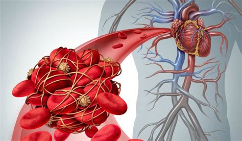 What is Thrombosis? | Vasculearn Network