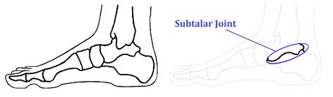 Subtalar Arthritis - Ankle, Foot and Orthotic Centre