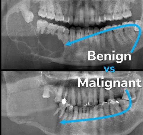 Benign Vs Malignant Medizzy