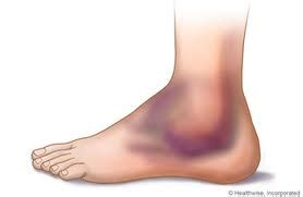 MOI|Signs|Symptoms - Inversion Ankle Sprain