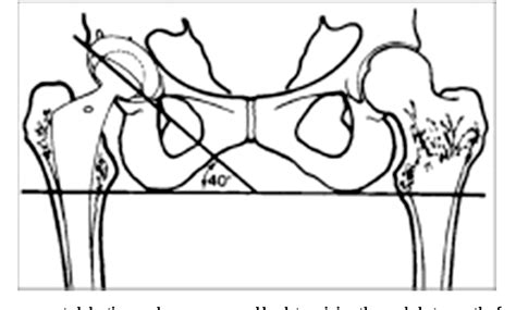 Figure 2 From How Does Pelvic Rotation Or Tilt Affect Radiographic