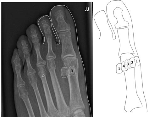 The Sesamoid Bone - Consulting Footpain