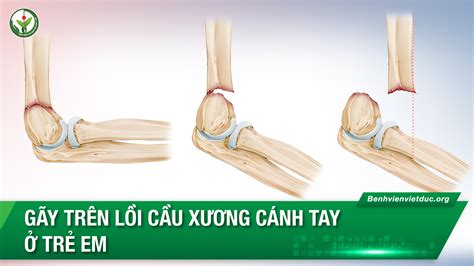 Giải phẫu lồi cầu xương cánh tay Cấu trúc Bệnh lý và Phục hồi Hiệu Quả