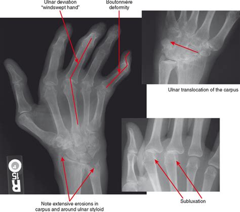 Rheumatoid Arthritis X Ray Neck