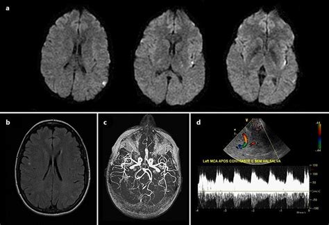 Mri Dwi Stroke