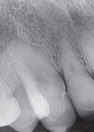 Intraoral periapical radiograph of the maxillary right canine ...